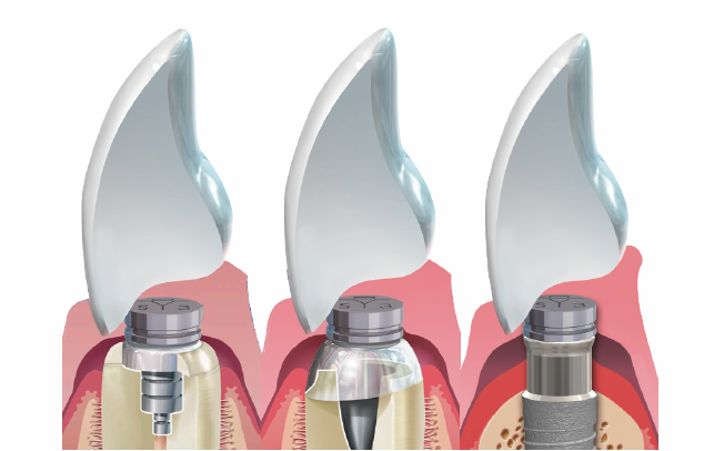 Dyna Magnet / Attachment