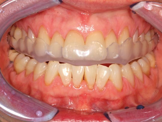 PrimoSplint Boks á 12 stenger