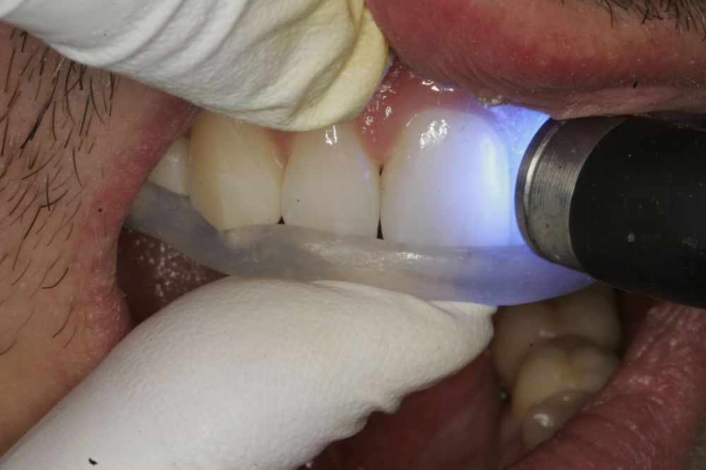 PrimoSplint Boks á 12 stenger