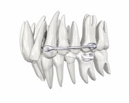 Master Kit - Carriere® Motion™ Clear Class II (6 sets)
