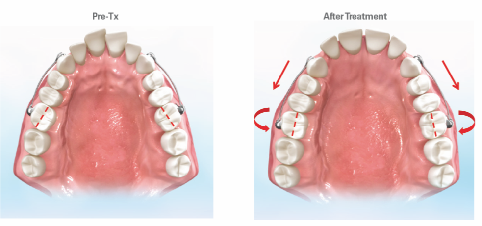 Carriere Motion Clear Class II 