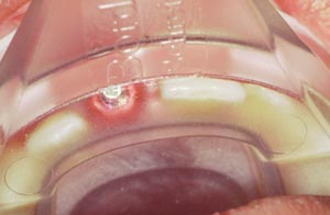 Border-Lock, Implant, Upper