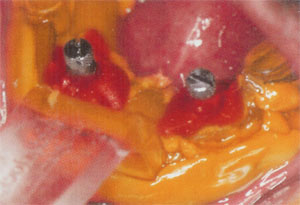 Border-Lock, Implant, Lower