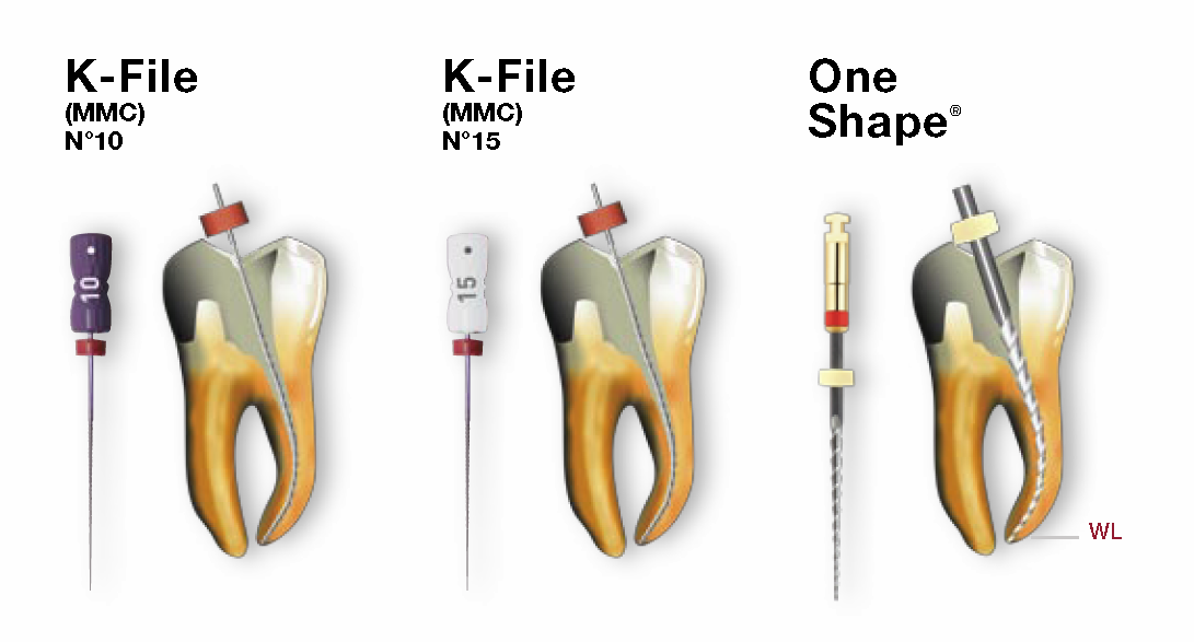 One Shape - Endo Kit