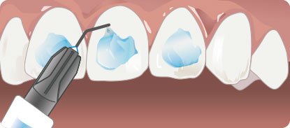 GC Ortho Etching Gel