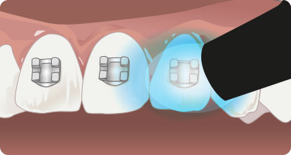 GC Ortho Etching Gel