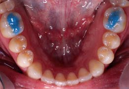 UltraBand-lok - Natural