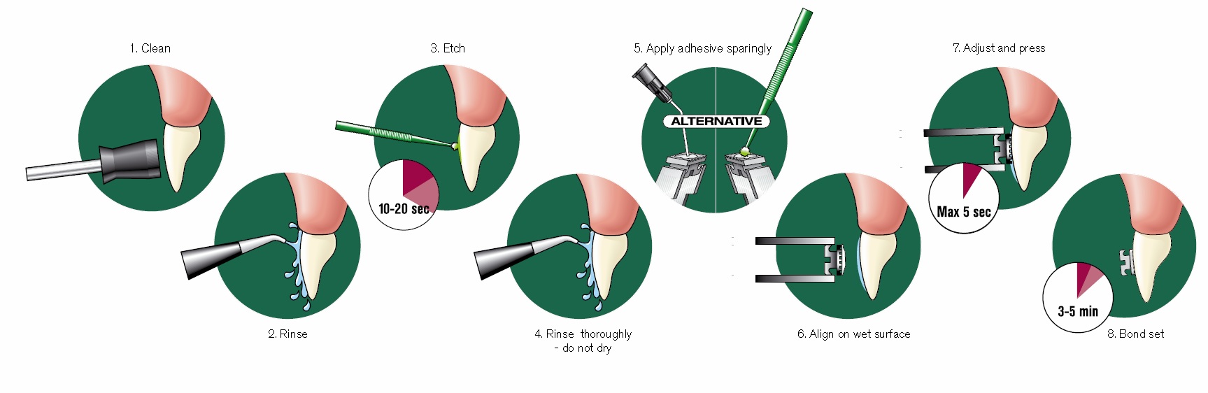 SmartBond Luer-lock Tips